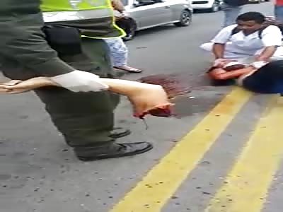 Woman dismembered arm in accident