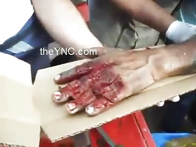 Work accident hand remove a machine