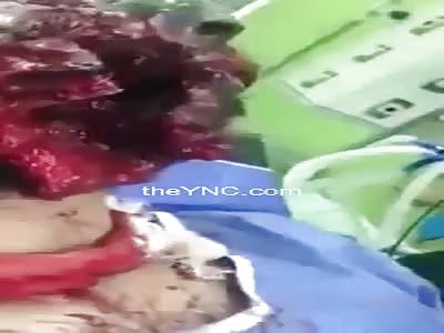 Face Disfigured By a Shot But Still Alive