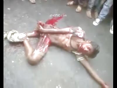 The Man Still Living With His 2 Legs Crushed By A Truck