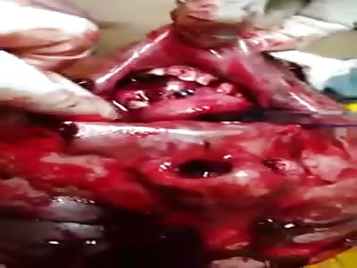 His Face Disfigured Man After Assault At A Party