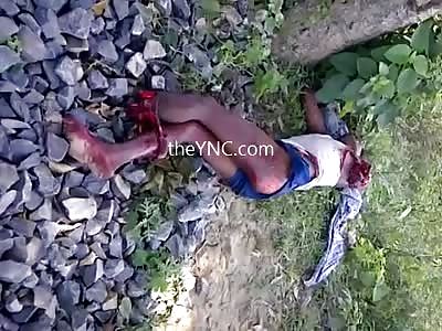 The Dying Man With His Leg And Arm Severed By A Train