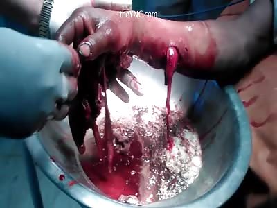 The Hand Of A Man Was Destroyed By A Hydraulic Press