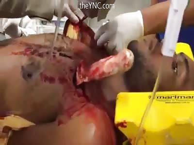 The Stabbed Man Stands With The Knife Stuck In His Heart