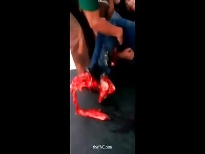 Motorcyclist Man With His 2 Feet Crushed By A Truck