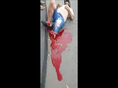 Motorcycle Accident - Severed Leg