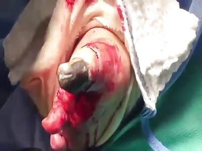 GANGRENOUS TOE IS AMPUTATED