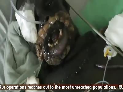 DO YOU REMEMBER OREM? (SECOND SURGERY DONE)