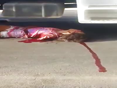 WOMAN LOSES ARM AND FRACTURE THE FEMUR IN ACCIDENT