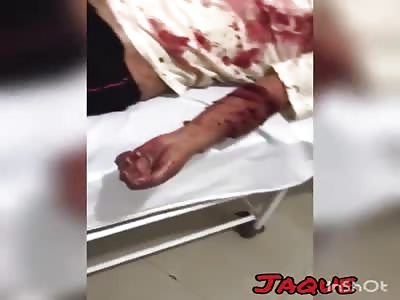 VICTIM OF EXTENSIVE BODY WOUNDS