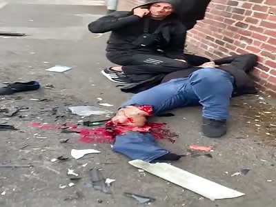 MAN'S LEG DESTROEYD IN AN ACCIDENT 