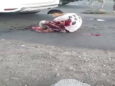 SHATTERED ARM BY RIFLE SHOT