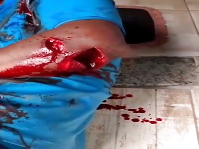 HE WAS ATTACKED WITH MACHETE BLOWS