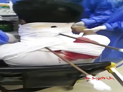 MAN WITH IRON BAR STICKED INTO THE BODY