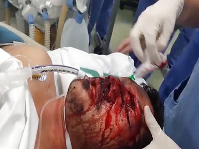  MAN SUFFERED AN ACCIDENT WITH A HYDRAULIC HOSE