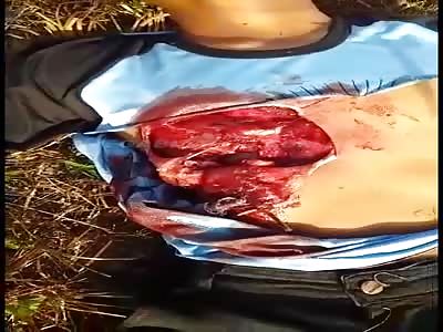 Biker's chest ripped open on barbed wire fence.