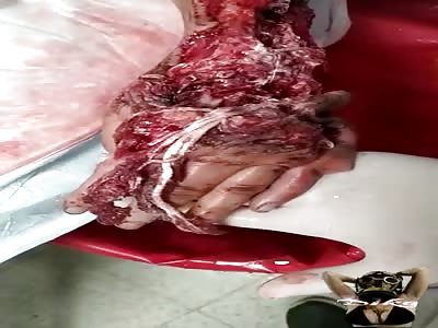 HAND TOTALLY FUCKED UP