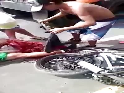 LEG DESTROYED IN AN ACCIDENT 