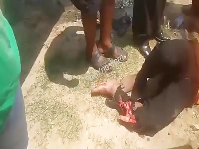 Terrible injured in leg in motorbike Accident.