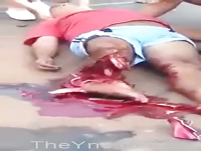 Woman with leg fucked up after accident