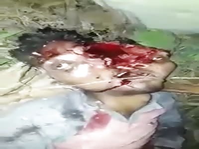 Horrible Divided Face After accident