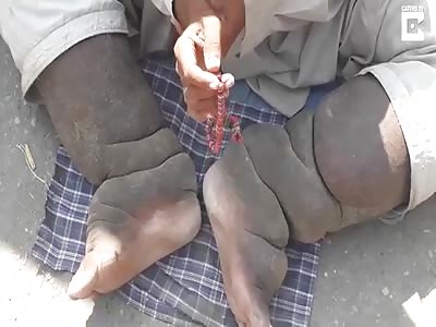 Man Has Legs Weighing Two Stone Each