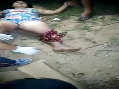 woman leg fucked in accident