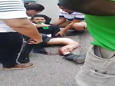 Leg fucked in Accident