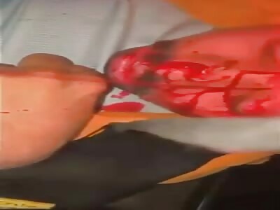 Drunk Driver Skull Cracks on Impact