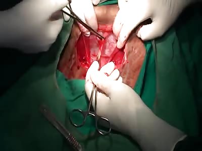 cesarean birth - C Section 