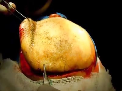  removing a brain clot