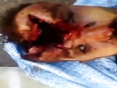  Two men without a brain