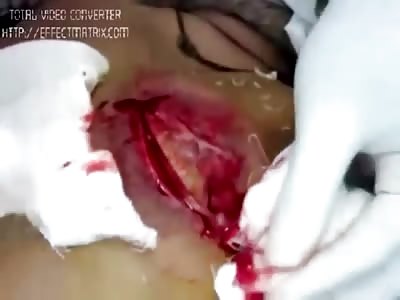 Best Terrible Infection - Abscess-Cyst-Pimple-Acne Removal