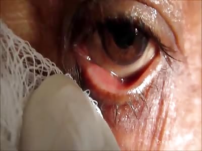 Lacrimal Sac Abscess Drainage