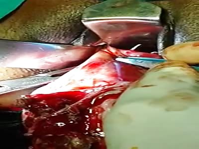 Vaginal Salpingo oophorectomy  large Dermoid cyst