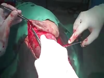Brain tumor extraction