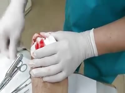 Nail surgery buried with suture