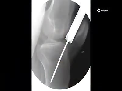  TIBIA FRACTURE Correction Surgery (Motorcycle Accident)