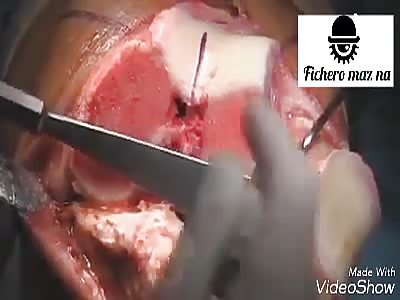 Knee transplantation