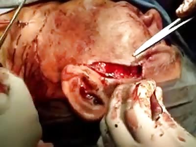 Reconstruction of the face by cancer. Awesome pictures