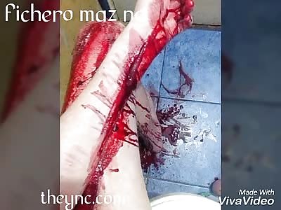 Very extreme self-mutilation  (graphic)