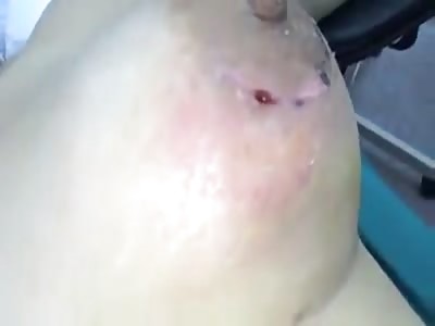 Infected breast implants  (1)