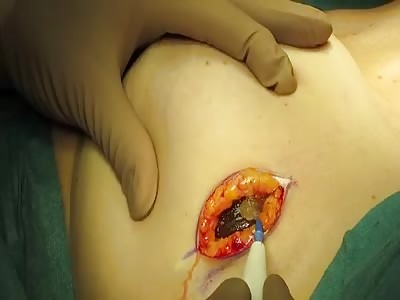 Removal of leaking silicone implant at Avenue Plastic Surgery