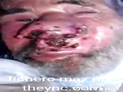 You will rot your nose by consuming poor quality cocaine part 1