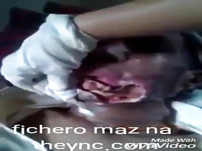 black with cancer in the mouth