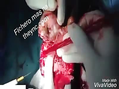 Amputating diabetic foot