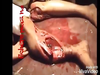 Thus heal the bones in the countries of the third world