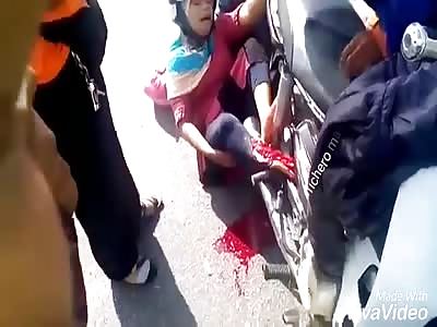 Woman with shattered foot