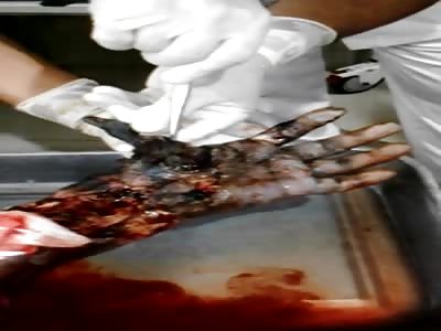 Electrical hand amputation