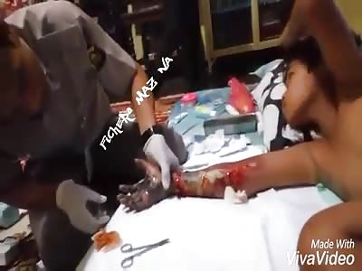 Hand burned with boiled water